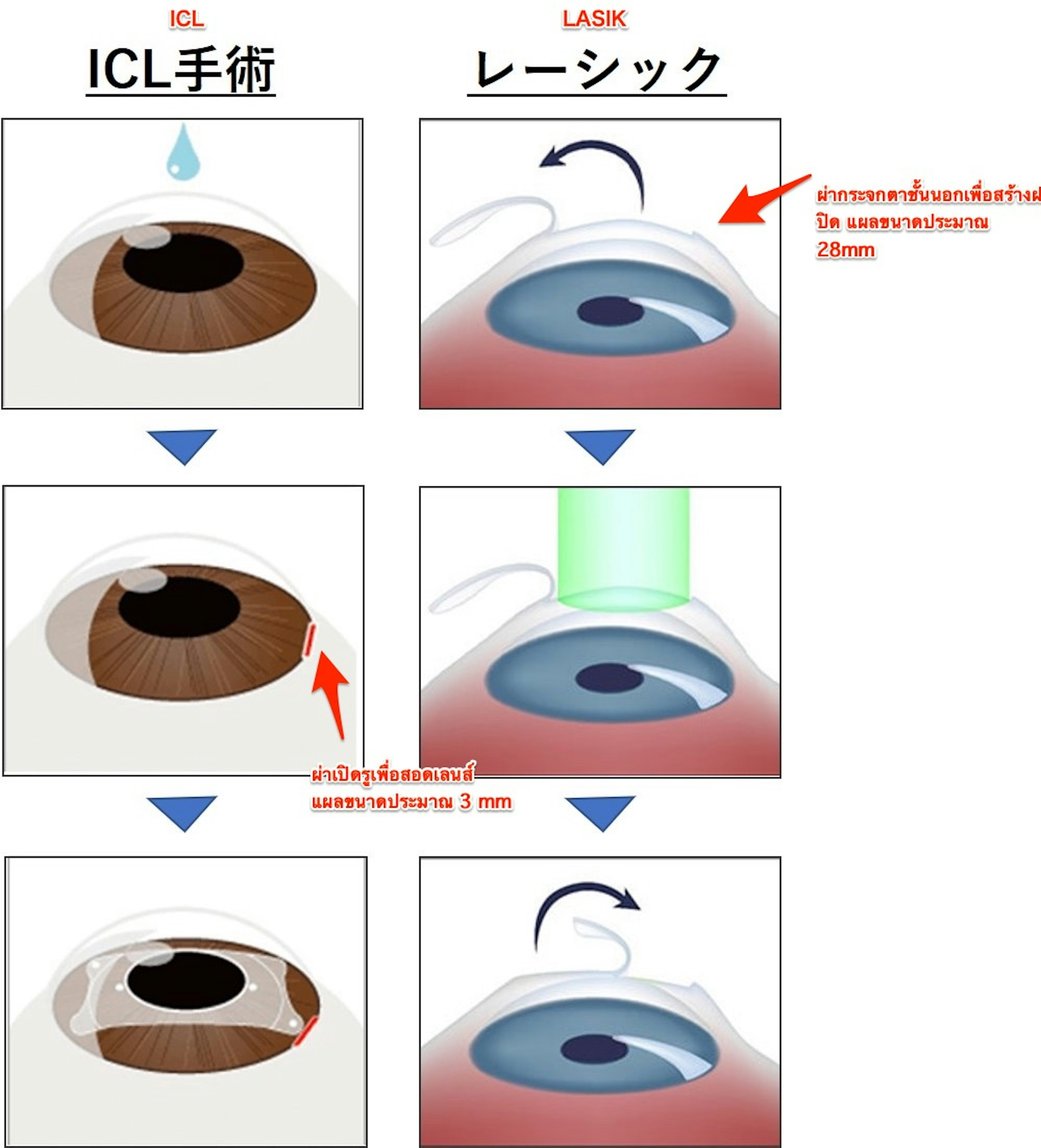 รูปเปรียบเทียบขั้นตอนการทำ ICL กับ LASIK