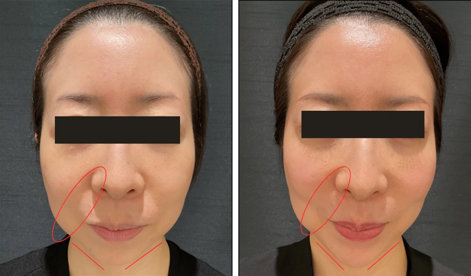 44歳 / ほうれい線ボリューマ+顎ボラックス