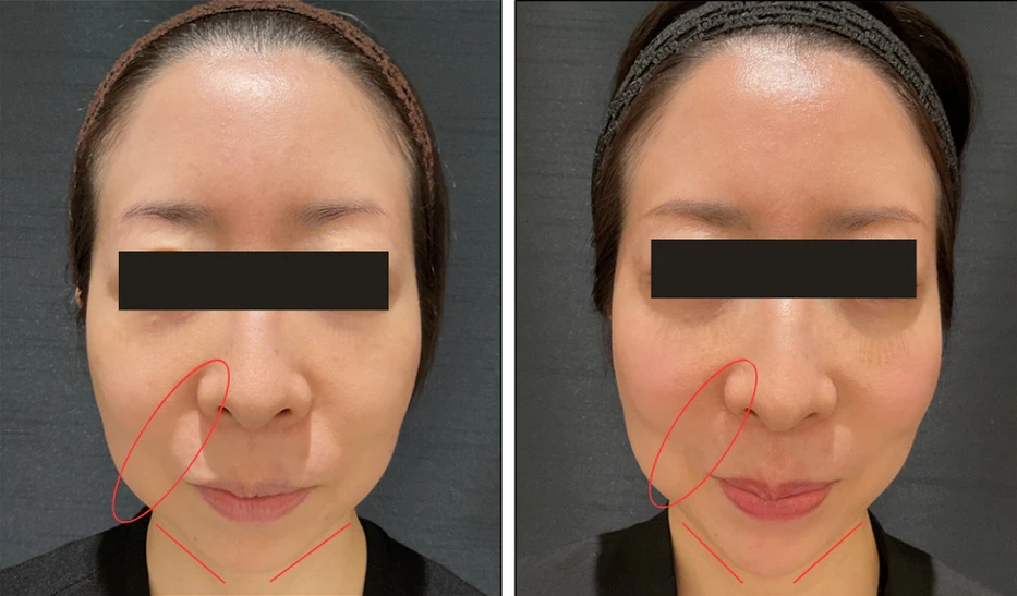 44歳 / ほうれい線ボリューマ+顎ボラックス