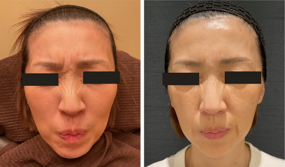 53歳 / 眉間・鼻根ボトックス