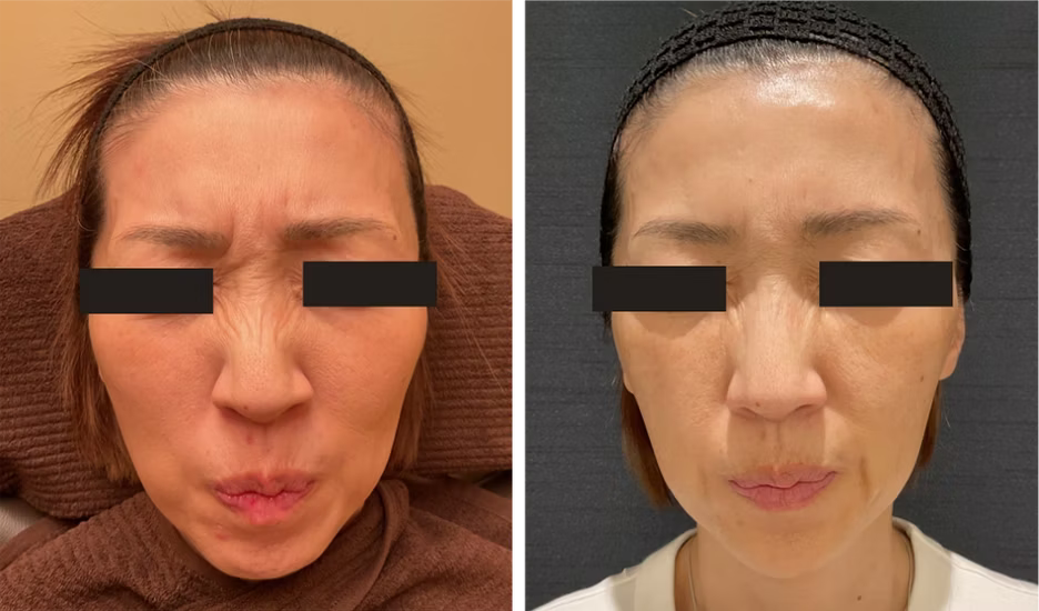 53歳 / 眉間・鼻根ボトックス