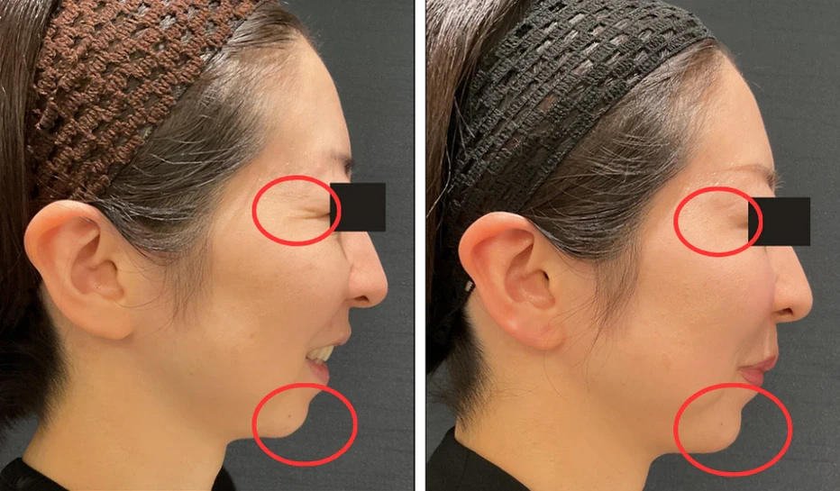 44歳 / 目尻ボトックス+顎ボラックス