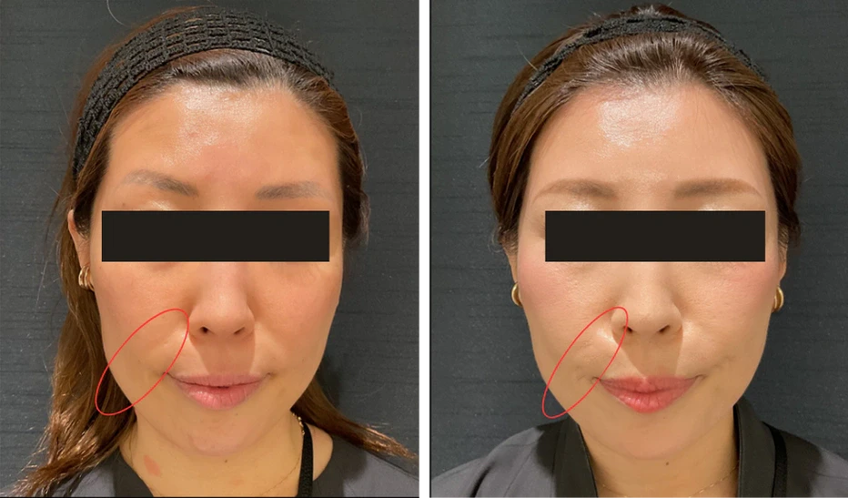 38歳 / ほうれい線ボリューマ