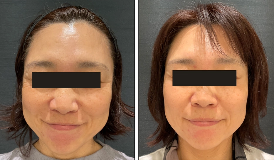 50歳 / 目尻ボトックス