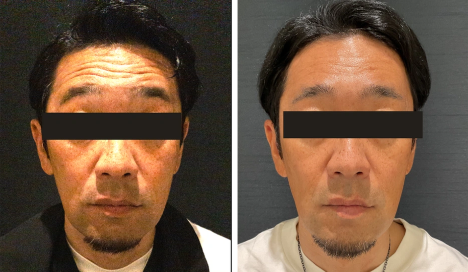 51歳 / 額ボトックス