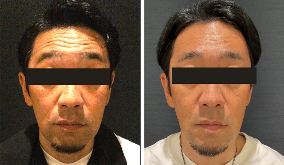 51歳 / 額ボトックス