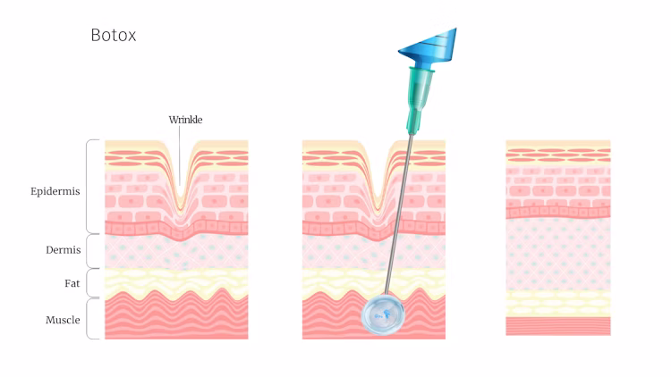Cross-section illustration showing how Botox works on skin and muscle layers