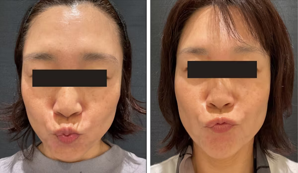 50歳 / 人中ボトックス