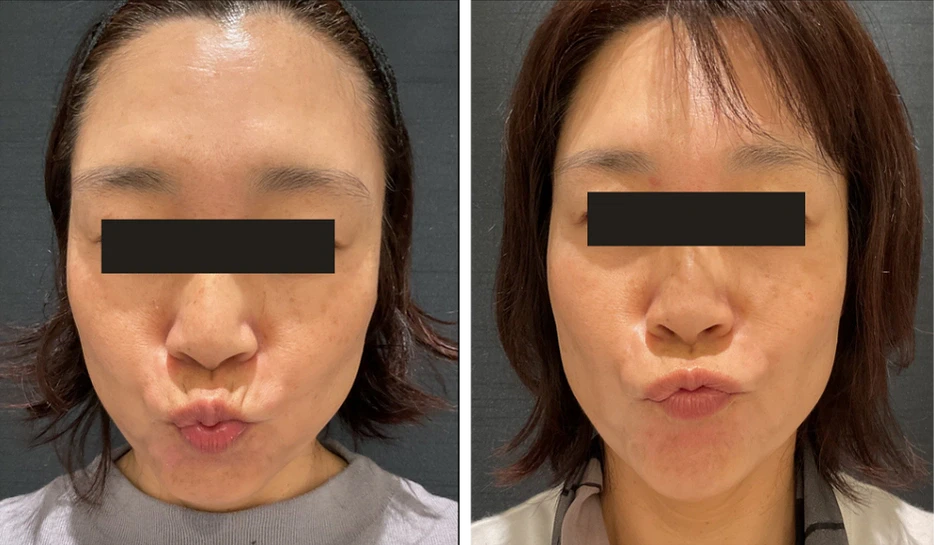 50歳 / 人中ボトックス