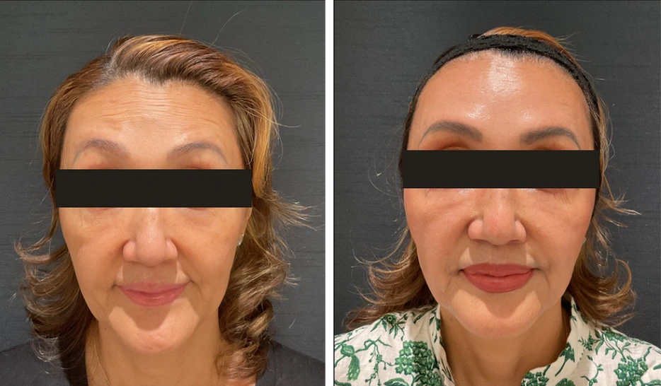 60歳 / 額ボトックス