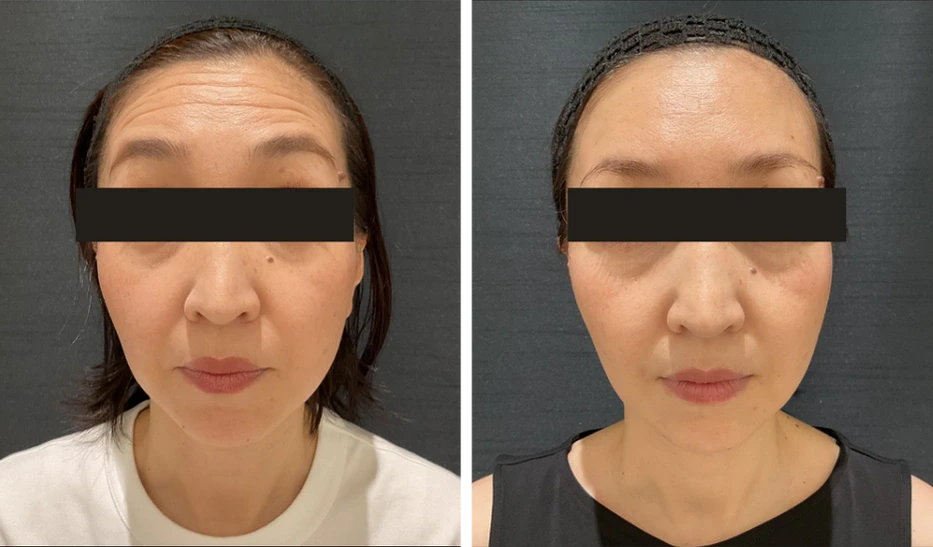 48歳 / 額ボトックス + ボライト