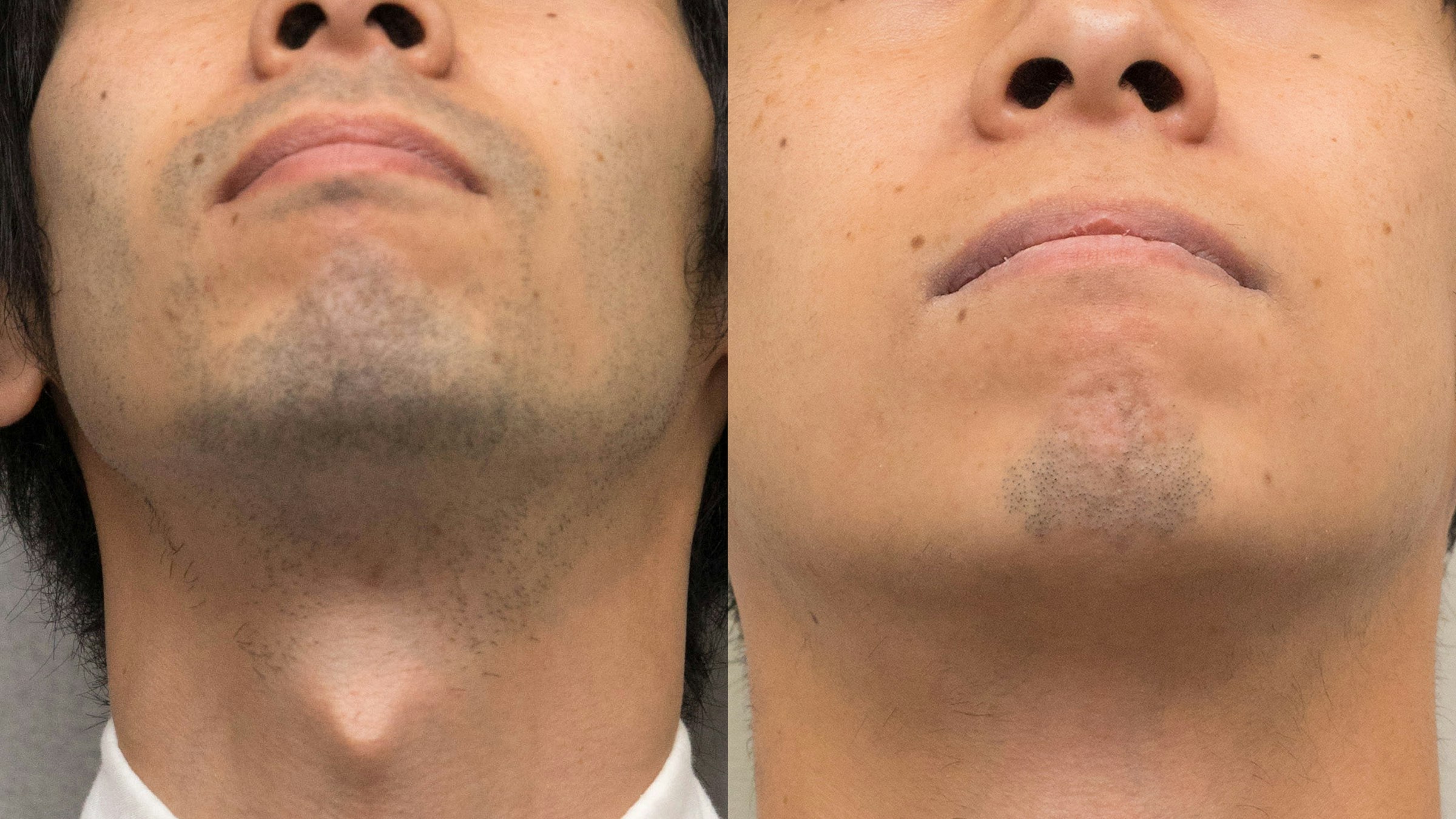 画像: 左が施術前、右が11回目の施術後。脱毛した部位は鼻下・アゴ・アゴ下・ほほ・もみあげ・首。明らかにヒゲがなくなっているのがわかる