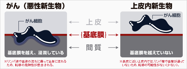 がん(悪性新生物)と上皮内新生物の違い
