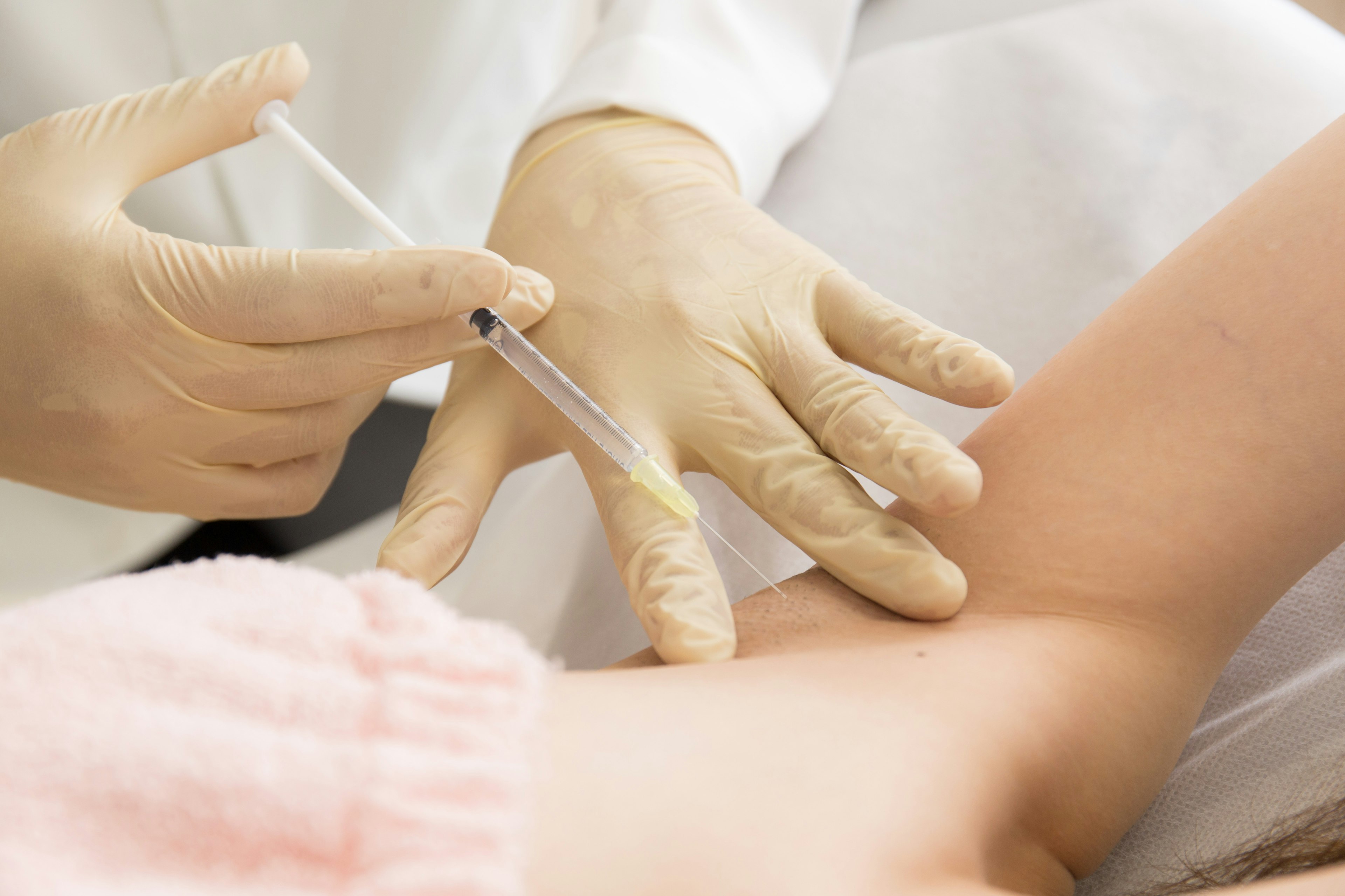 わきボトックス注射