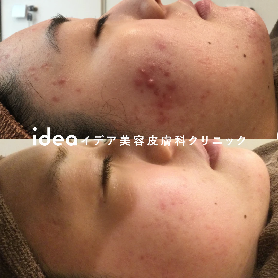 マクロゴールピールバイオニックセルサー 10回