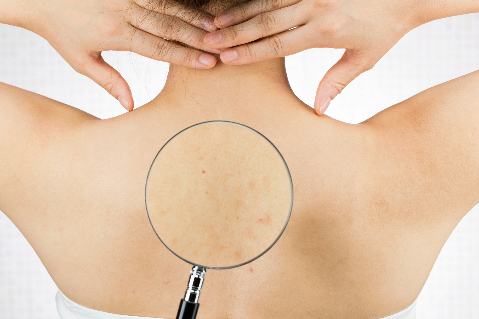 背中ニキビの原因や症状、予防法を解説!ニキビ跡を改善するには