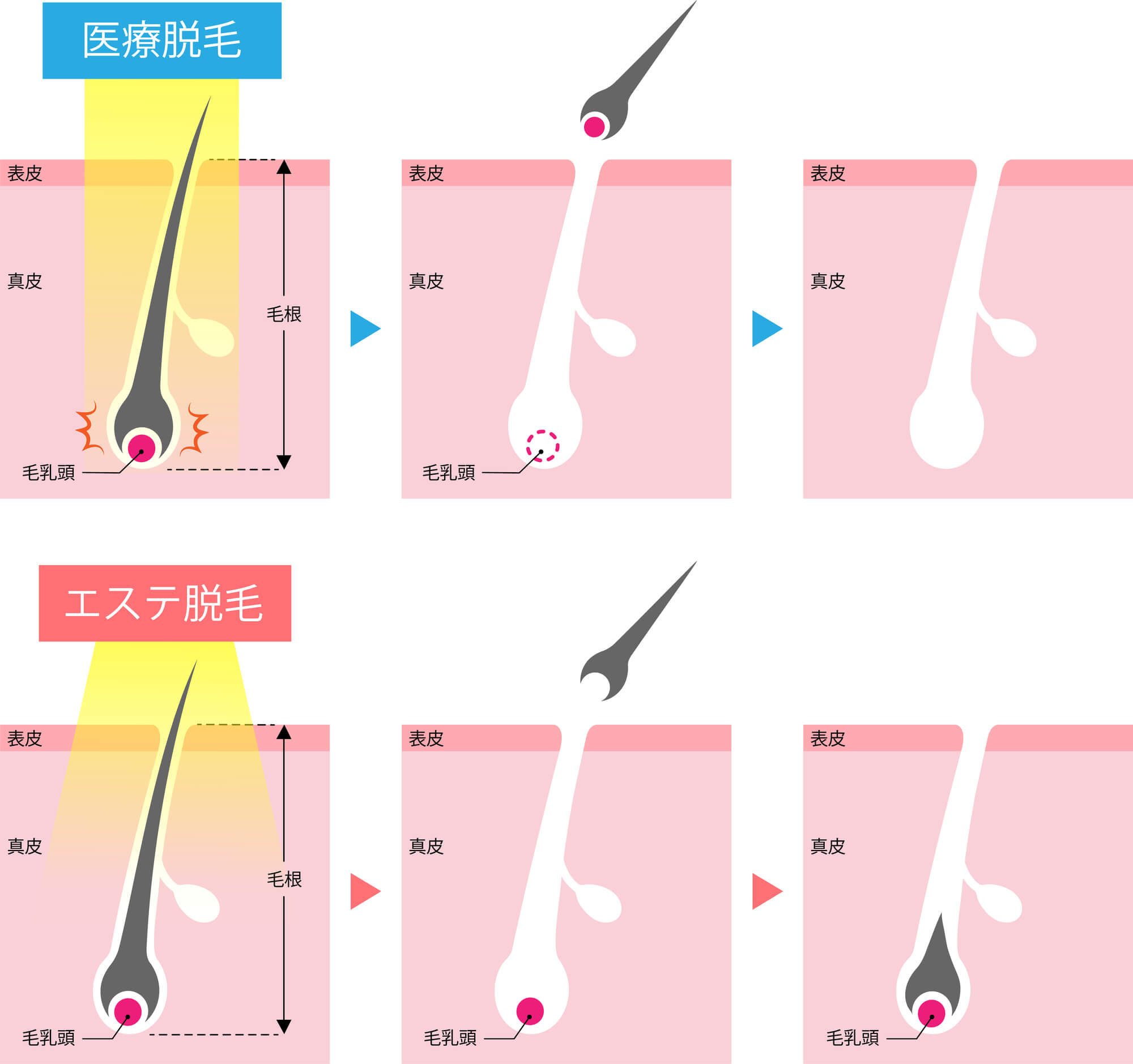 脱毛するなら石鹸 病院 セール エステ