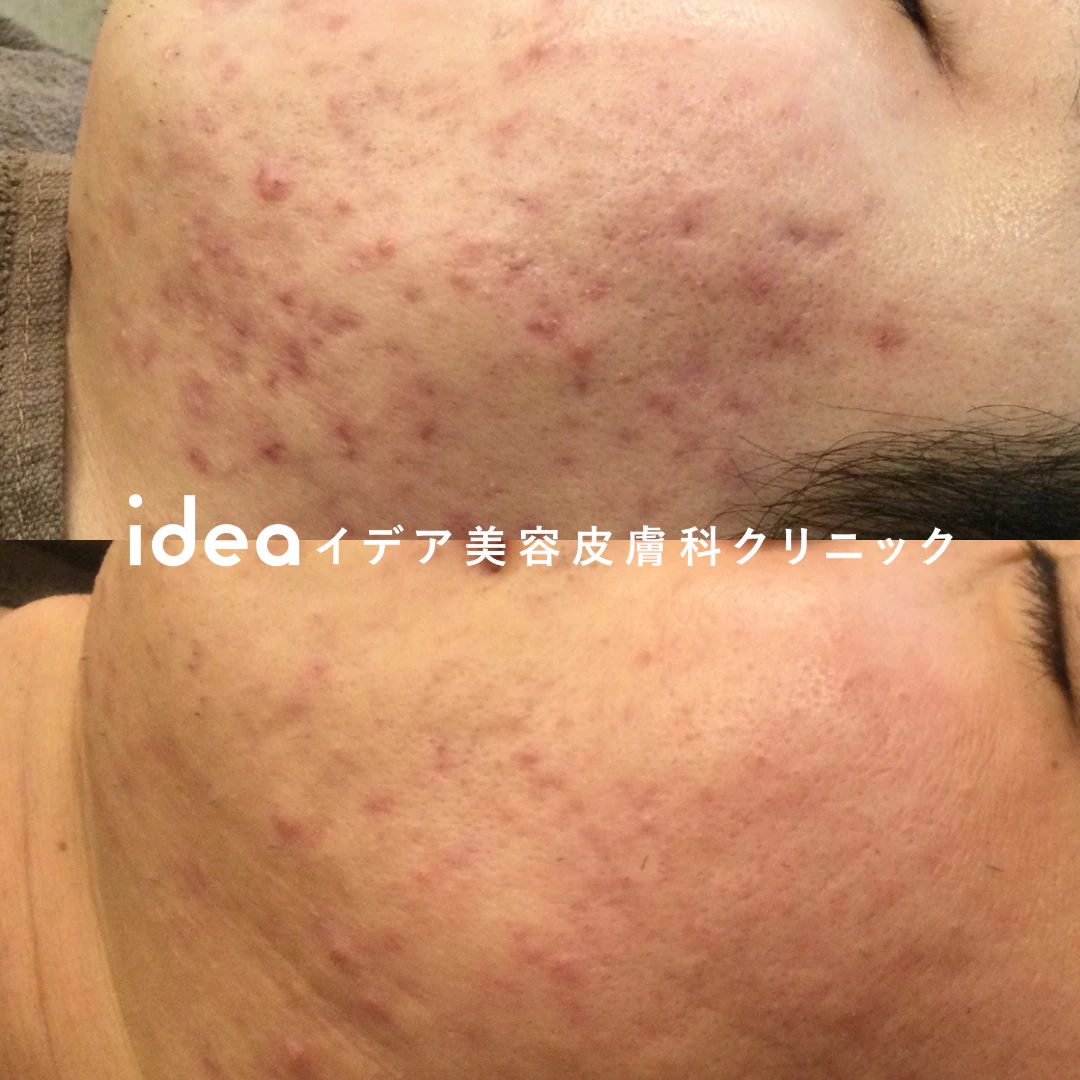 マクロゴールピールバイオニックセルサー 9回