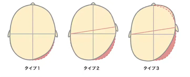 斜頭症分類