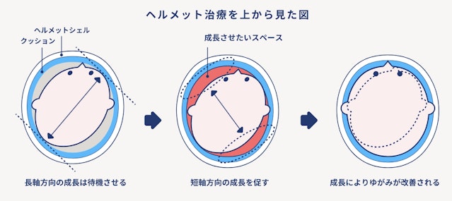 ヘルメット治療を上から見た図