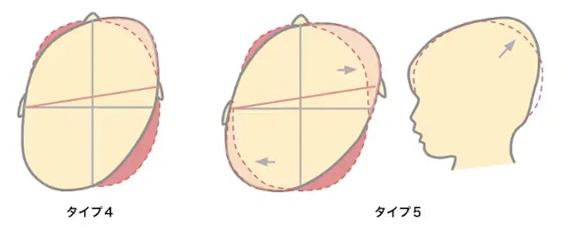 斜頭症分類