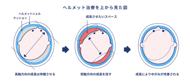 ヘルメット治療の仕組み