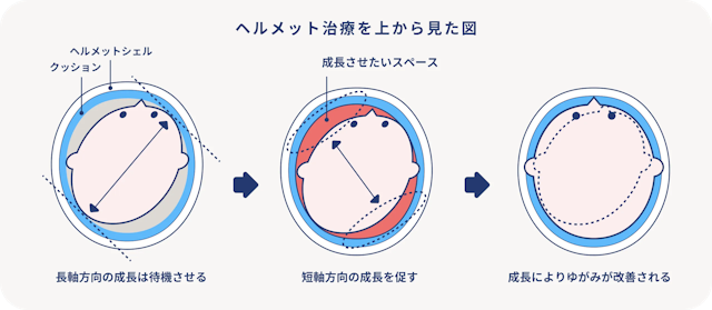 ヘルメット治療の仕組み