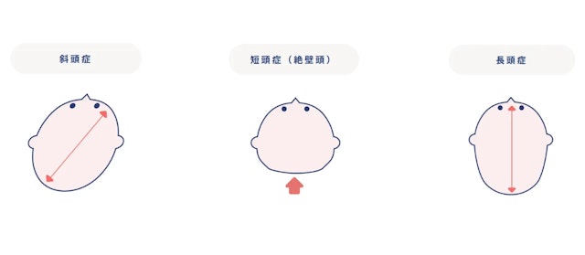 頭のゆがみの種類