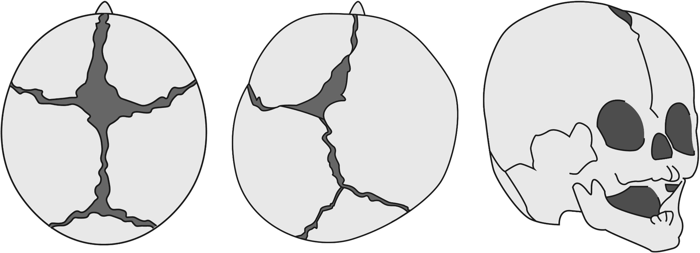 頭蓋骨癒合症の手術の生存率はどれくらいですか?