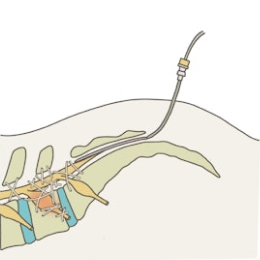 RACZ(ラクツ)カテーテル