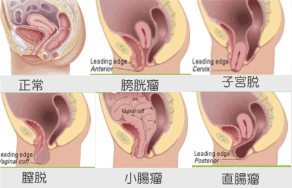 骨盤底筋 断面