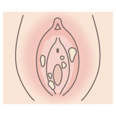 膣カンジダの症状を現したイラスト画像