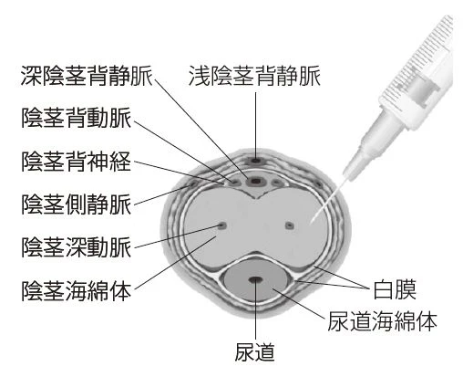 PGE1 陰茎海綿体注射