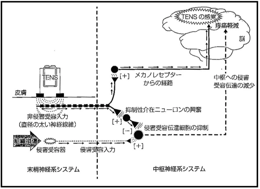 TENS 月経痛緩和 ゲートコントロール ペインゲート