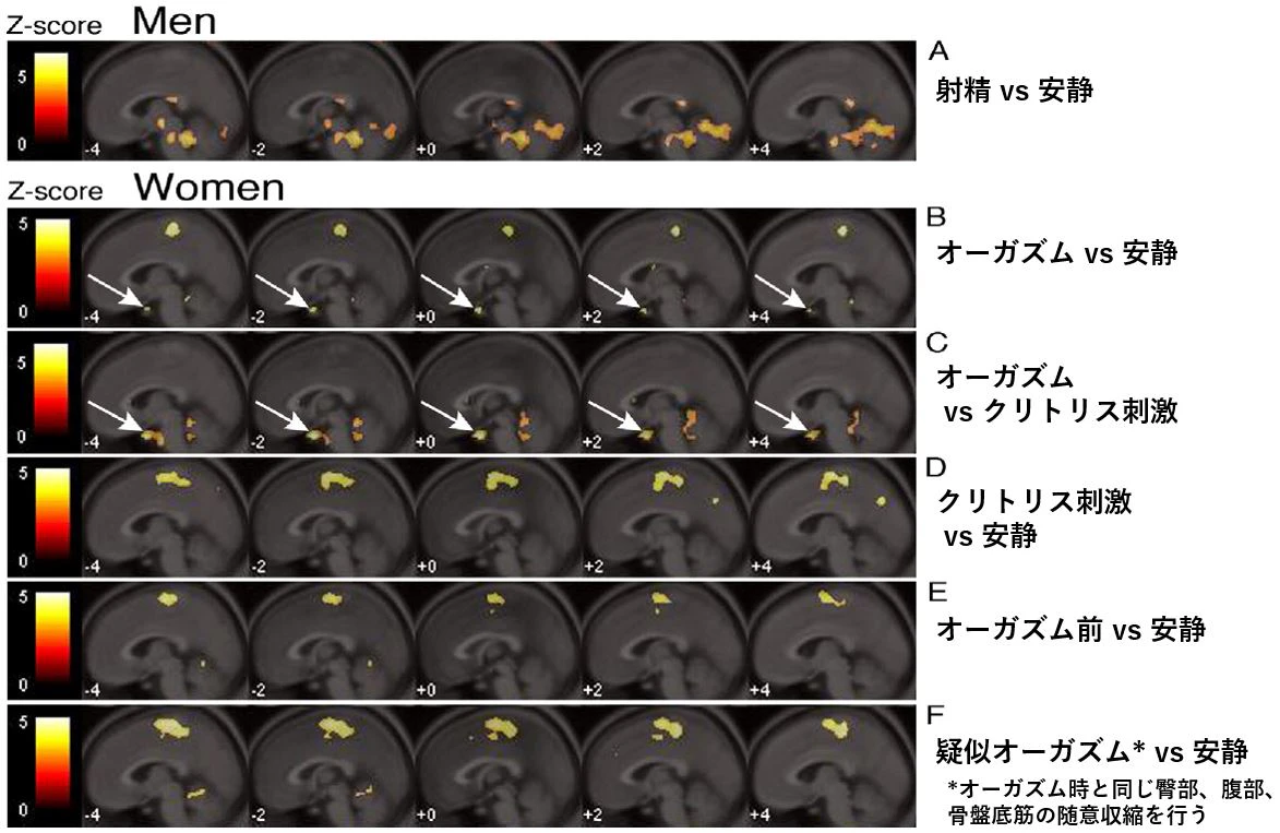 オーガズム　脳活動　fMRI　下垂体　オキシトシン