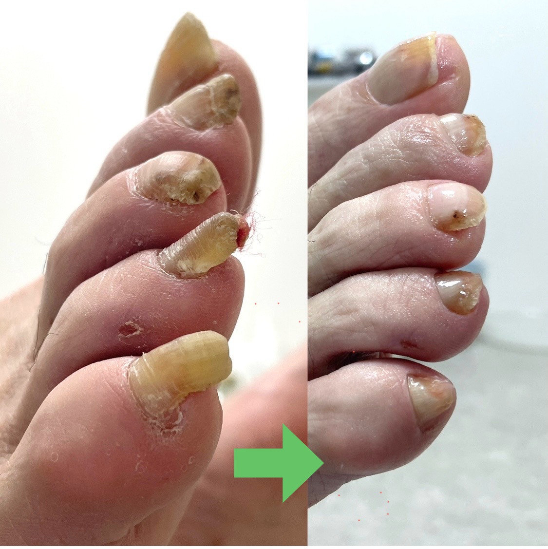 足爪カットBコース（肥厚爪）