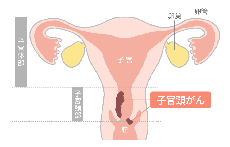 子宮頸がんとは