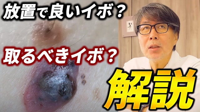 取らなきゃいけないイボと、自宅でできる改善&予防法について解説