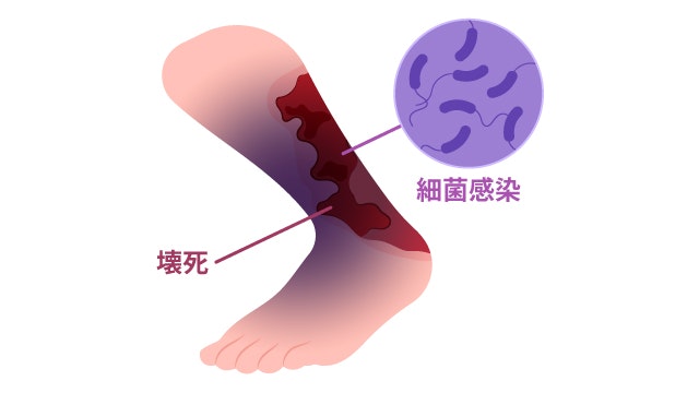 壊死性筋膜炎について説明する図です