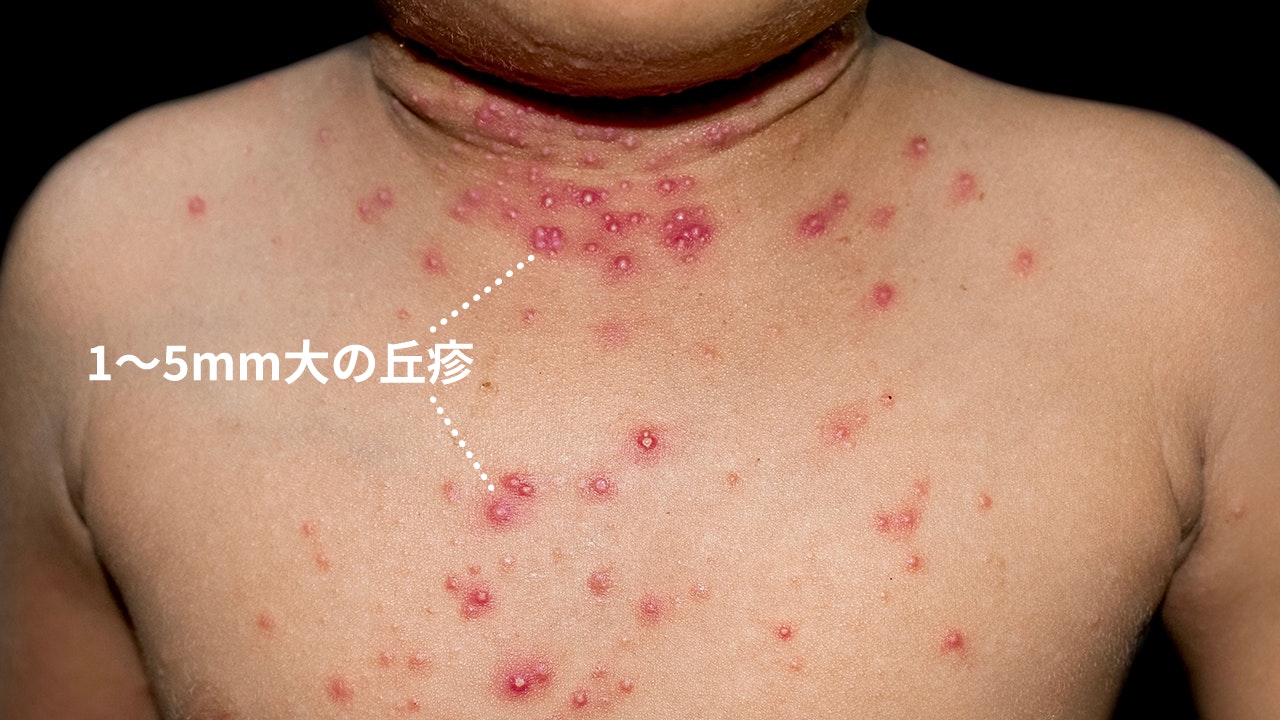 水いぼ（伝染性軟属腫）の症例写真。子供の首から胸にかけて広がった「1～5mm大の丘疹（小さな盛り上がり）」の群集。ウイルス感染により、肌色からピンク色の光沢あるイボが多発している皮膚症状の様子。