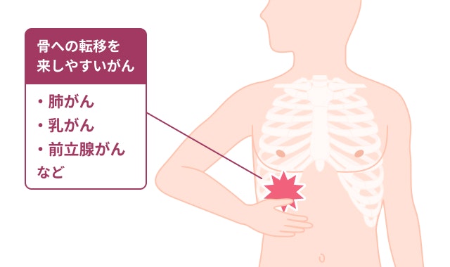 骨への転移を来しやすいがんを説明する図です