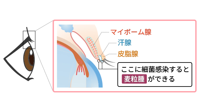 ものもらい」とはどのような病気ですか？ ｜ものもらい