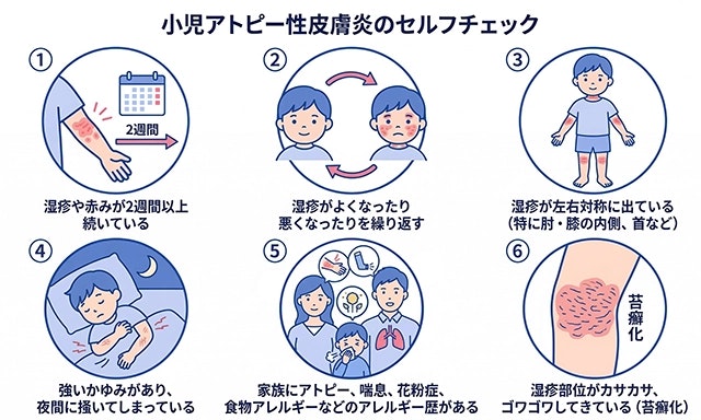 小児アトピー性皮膚炎のセルフチェック項目として、長引く赤みや反復する症状、左右対称の湿疹、夜間の強いかゆみ、家族のアレルギー歴、皮膚のゴワつき（苔癬化）など6つの特徴を分かりやすくまとめたイラスト。