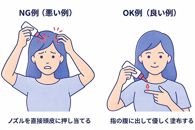 アトピー性皮膚炎による頭皮のかゆみに対する、外用薬の正しい塗り方を比較したイラスト。ノズルを直接頭皮に押し当てるNG例と、指の腹に薬を出して優しく塗布するOK例を対比して描写しています。