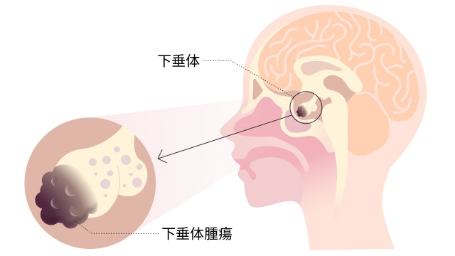 下垂体腫瘍を説明する図です