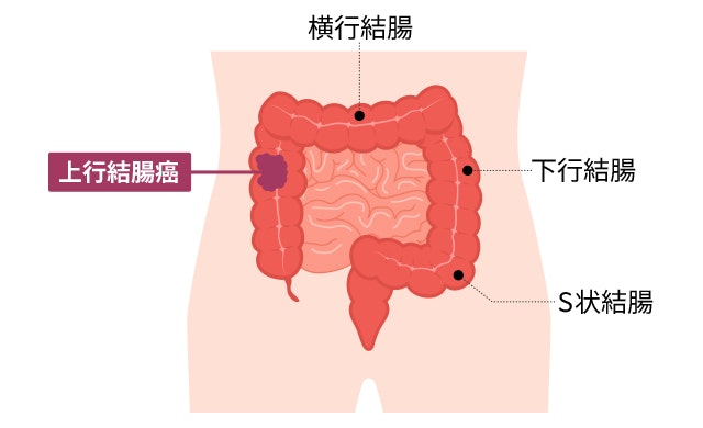 上行結腸癌のイラスト