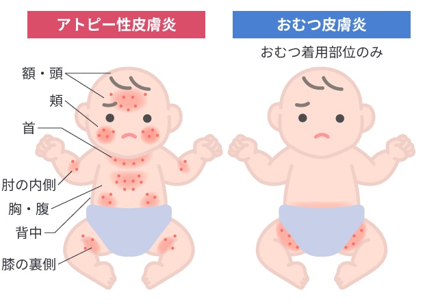 アトピー性皮膚炎とおむつ皮膚炎の赤ちゃんにおける湿疹部位の違いを比較したイラスト。アトピーは顔や関節部など全身に赤みが出るのに対し、おむつ皮膚炎はおむつ着用部位に限定されることを視覚的に示しています。
