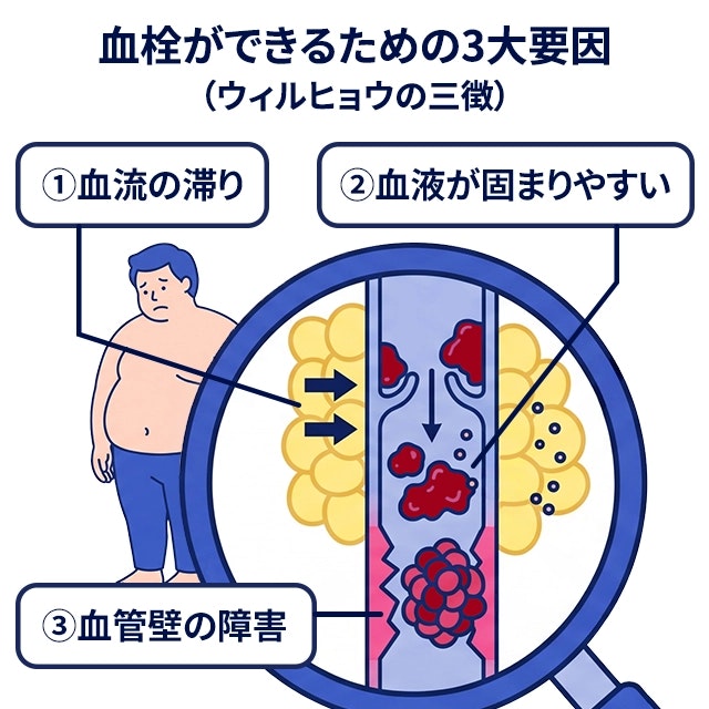 肥満症が血栓症(エコノミークラス症候群)のリスクを高める要因を、血流の滞り、血液の固まりやすさ、血管壁の障害の3点から、血管内に血栓ができる拡大図を用いて解説した図です。