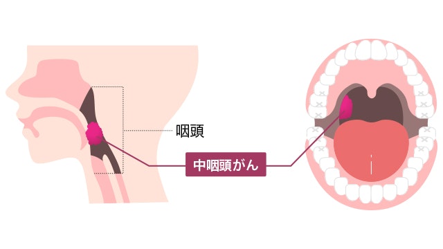 中咽頭がんの見た目を説明する図です