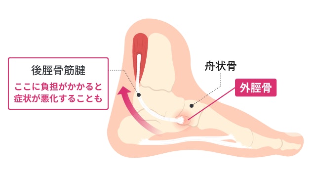 有痛性外脛骨の痛みの原因となる足の内側の構造を示した断面図。舟状骨の横にある外脛骨とそこに繋がる後脛骨筋腱が描かれており、腱に負担がかかると悪化の原因にもなることを矢印を用いて解説しています。